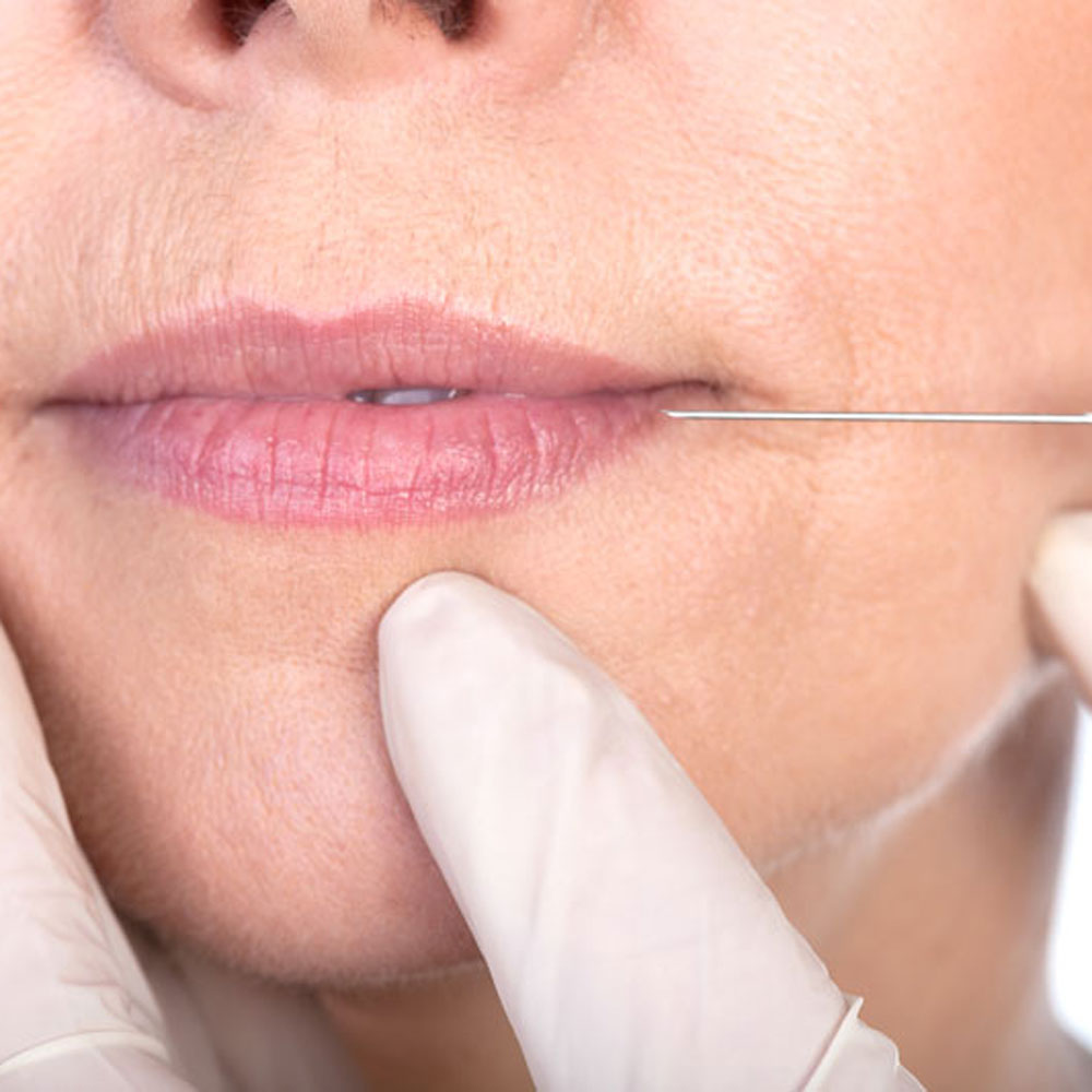 Dermal fillers image 3