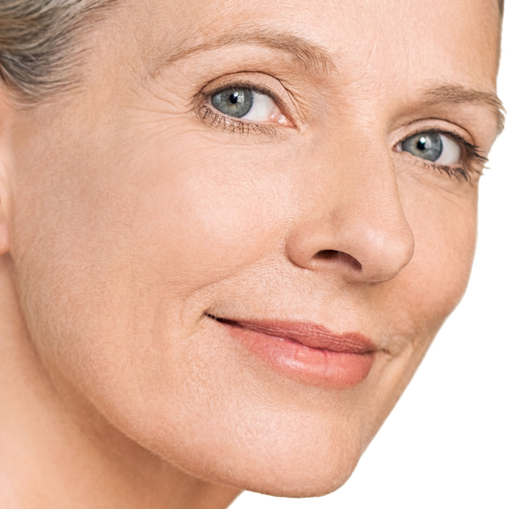 Anti-Wrinkle injection results image 1